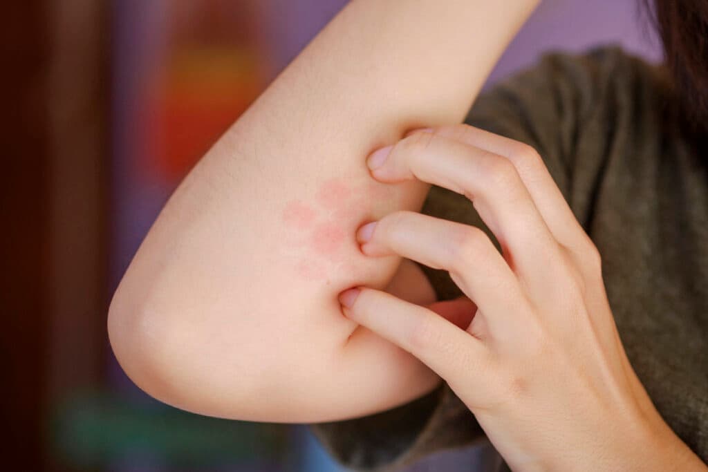 A woman is scratching a red blistered arm due to a foreign body intolerance or an insect bite.