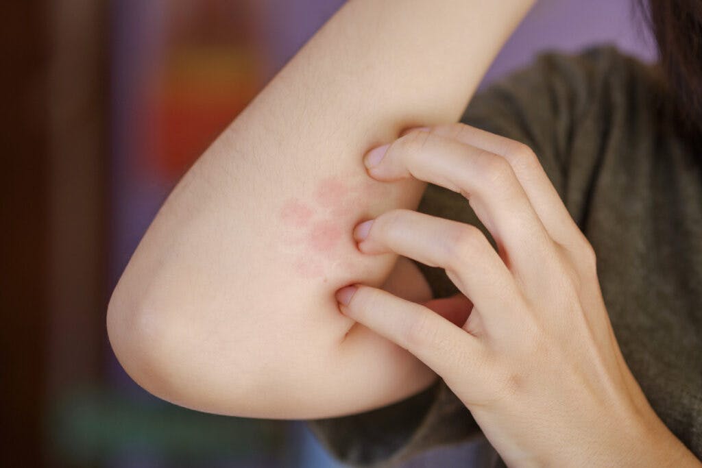A woman is scratching a red blistered arm due to a foreign body intolerance or an insect bite.